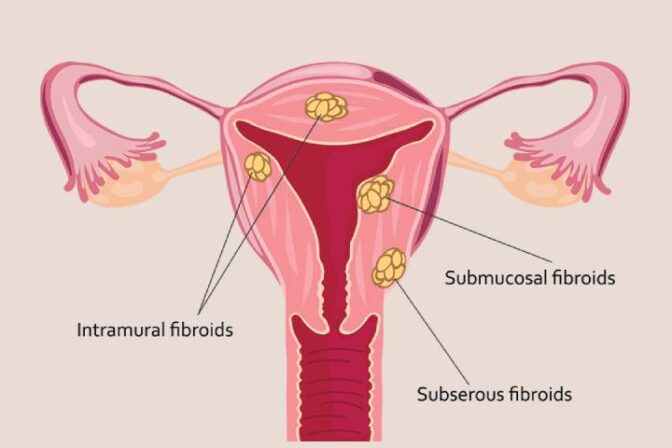 Uterine Fibroids Treatment in Punawale