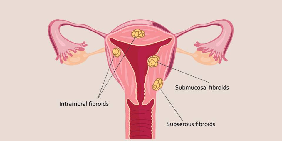 Uterine Fibroids Treatment in Punawale