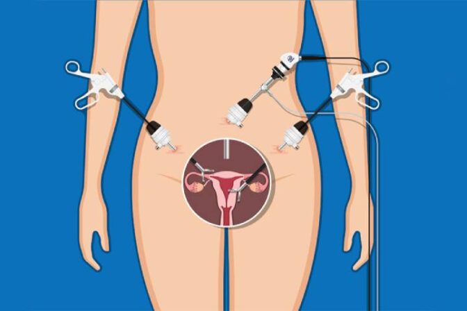 Endometriosis Treatment in Punawale