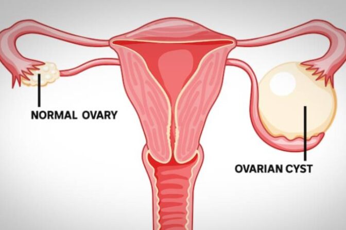 Ovarian Cyst