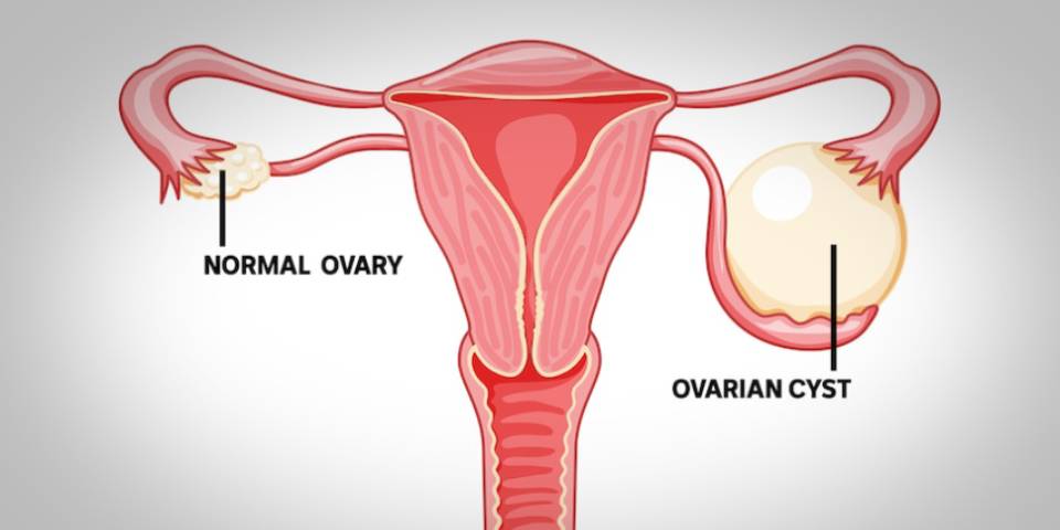 Ovarian Cyst