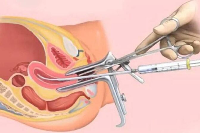 What You Need to Know About the IUI Procedure - Dr. Shraddha Galgali