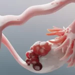 Ovarian cyst treatment consultation with Dr. Shraddha Galgali at Excella Women’s Wellness Clinic, Punawale, Pune