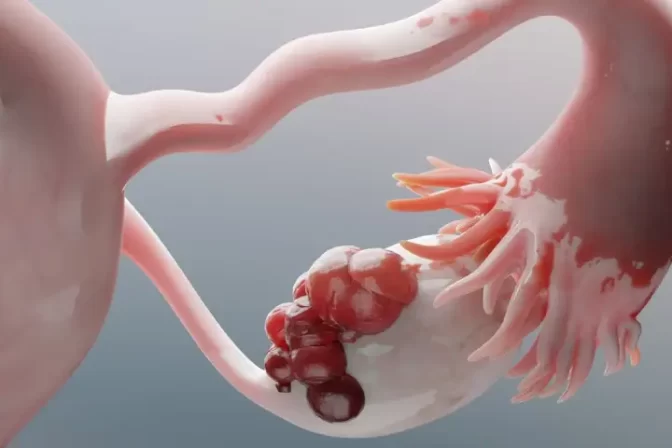 Ovarian cyst treatment consultation with Dr. Shraddha Galgali at Excella Women’s Wellness Clinic, Punawale, Pune