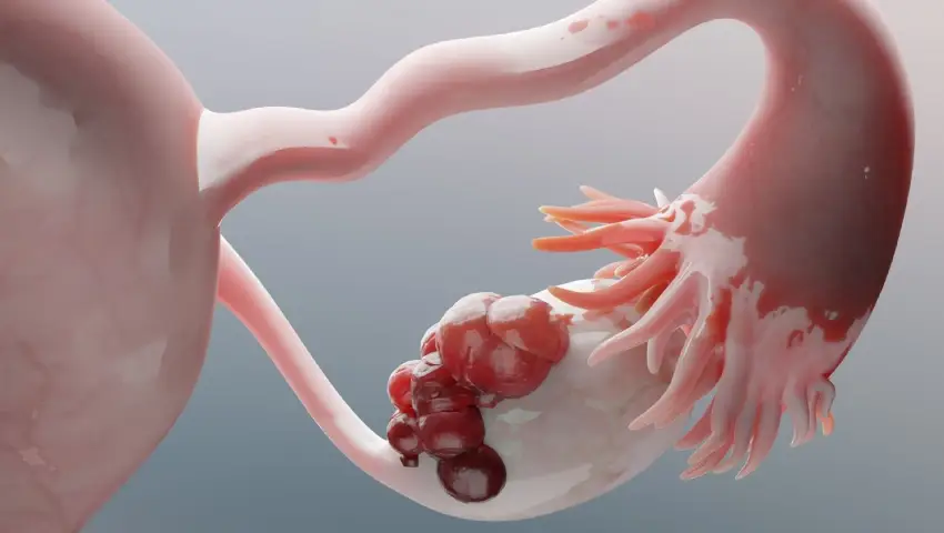 Ovarian cyst treatment consultation with Dr. Shraddha Galgali at Excella Women’s Wellness Clinic, Punawale, Pune